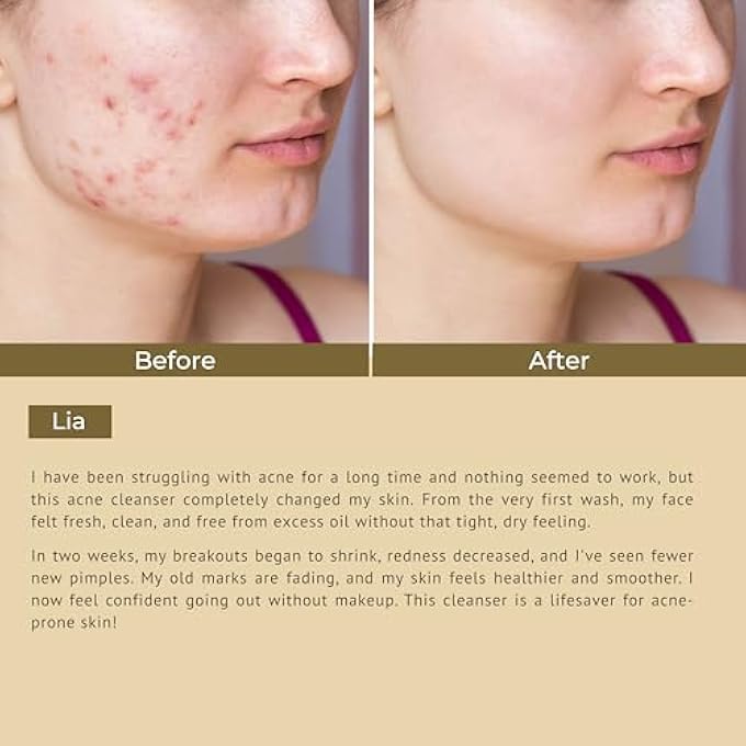 ROZE ACNE CONTROL CLEANSER | FOR TEEN & ADULT | FOR OILY OR ACNE PRONE SKIN - Image 4